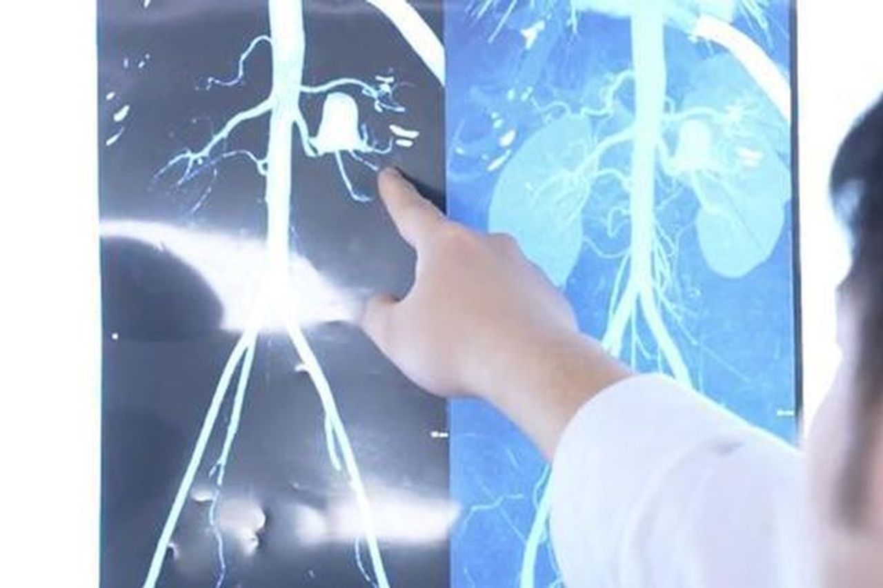 Lần đầu tiên tại Việt Nam: Ghép thận sau khi thận được lấy ra 'sửa chữa' - Báo Người Lao Động