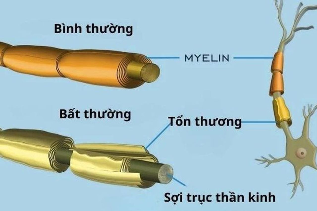 Người đàn ông ở Đắk Lắk mắc hội chứng hiếm Guillain-Barré - Báo Tri thức & Cuộc sống